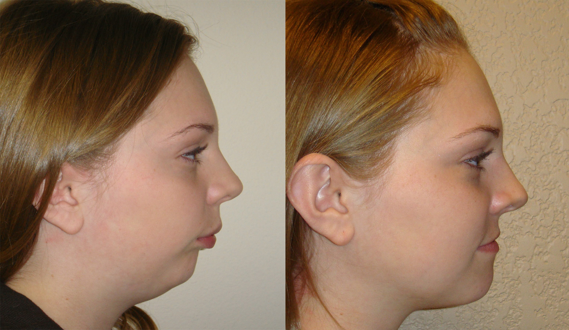 Surgical Orthodontics in Colorado Springs, CO Bailey Orthodontics